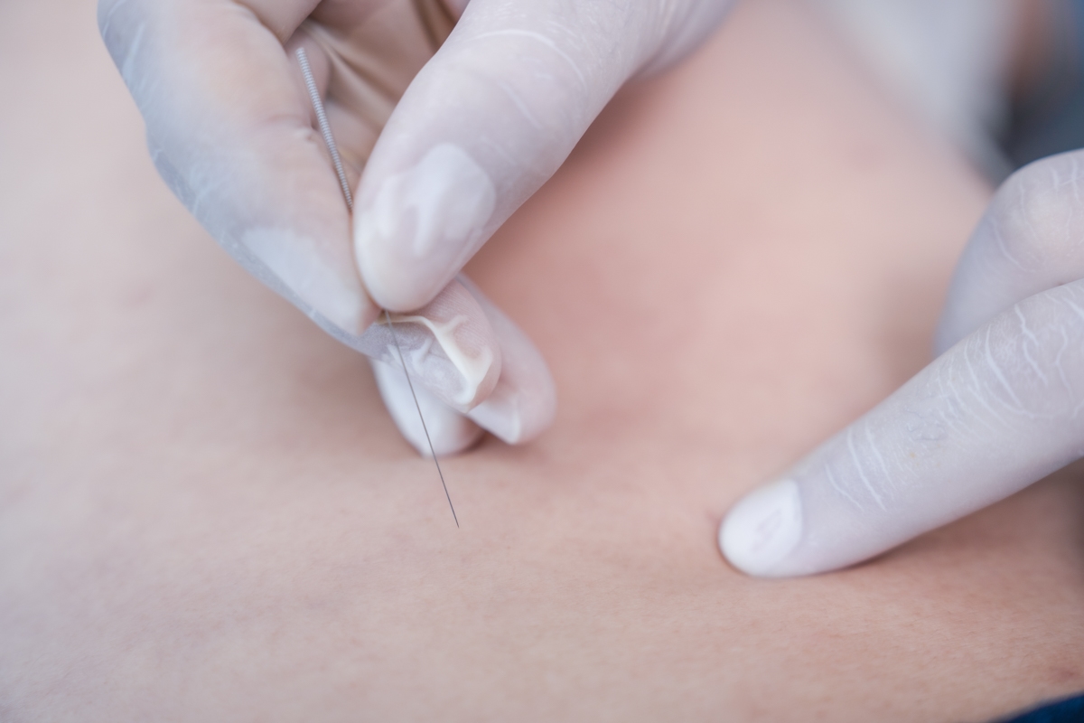 แพทย์แผนจีน ฝังเข็ม